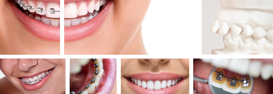 Zahnfehlstellung und Kieferfehlstellungen