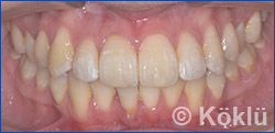 Zahnkorrektur - Beispiel Lingualtechnik nach der Behandlung