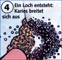 Loch im Zahn - Karies breitet sich aus