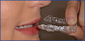 Invisalign 002