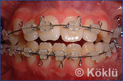 Patientenbeispiel Bracket Zahnspange Front
