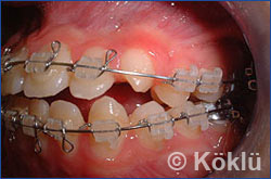 Patientenbeispiel Bracket Zahnspange Seite