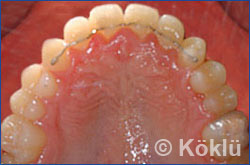 Patientenbeispiel Retainers - Lingualretainers Oberkiefer 