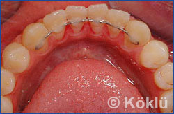 Patientenbeispiel Retainers - Lingualretainers Unterkiefer 